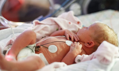 Photo of a premature baby in NICU